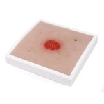 Wundmoulage Kolostoma, unter Hautniveau