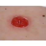 Wundmoulage Kolostoma, unter Hautniveau