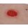 Wound Moulage Colostoma, below skin level, incl. stand