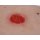 Wundmoulage Kolostoma, unter Hautniveau