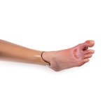 Wound foot with diabetic foot syndroms
