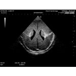Neonatales Ultraschall-Übungsphantom Kopf