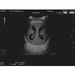 Ultrasound Neonatal Head Phantom with Hydrocephalus