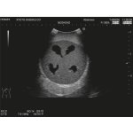 Ultrasound Neonatal Head Phantom with Hydrocephalus