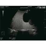 Intravesical Urine Volume Measurement Phantom