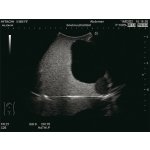 Intravesical Urine Volume Measurement Phantom