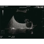 Intravesical Urine Volume Measurement Phantom