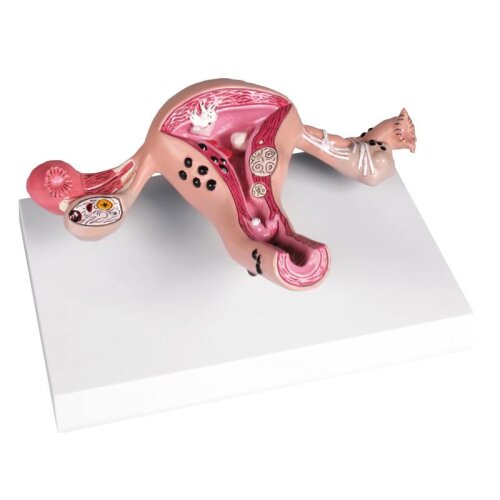 Uterus-Modell mit Erkrankungen