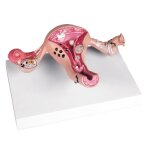 Uterus with diseases model