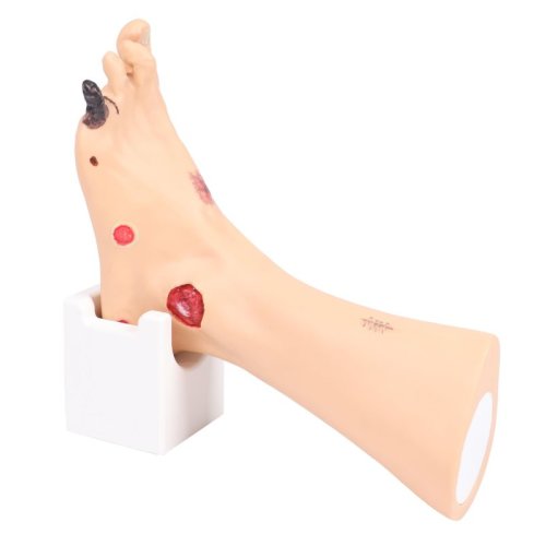 Wilma Wound Foot