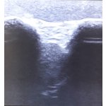 Ultrasound Training Shoulder