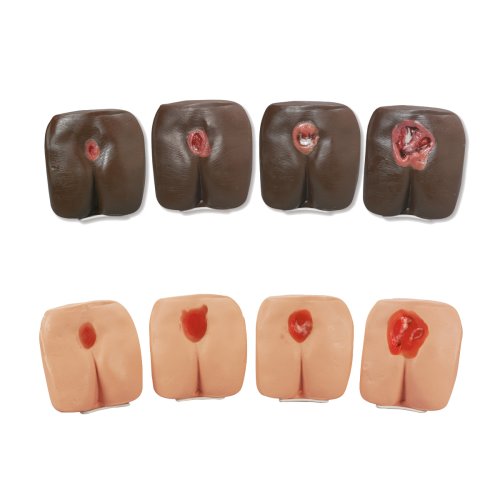 Pressure Ulcer / Bedsore Models