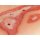 Wound moulage scalding