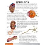 Typ II-Diabetes-Set