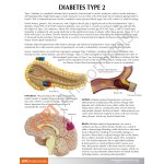 Typ II-Diabetes-Set