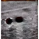SonoEZ paediatric ultrasound trainer "Femur"