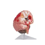 Brain Pathologies