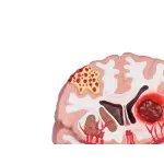 Brain Pathologies