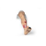 "Lena Leg" - Leg with medical conditions
