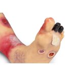 "Lena Leg" - Leg with medical conditions