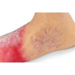 "Lena Leg" - Leg with medical conditions