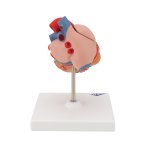 Heart Model with Left Ventricular Hypertrophy (LVH), 2 part - 3B Smart Anatomy