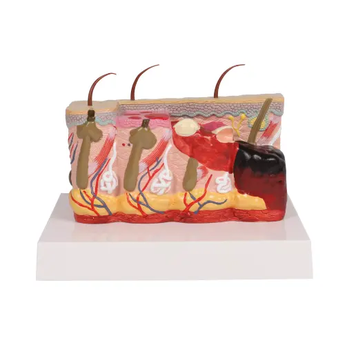 Pathological skin model with burns