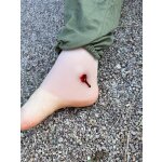 Wundmoulage Schuß Sprunggelenk