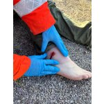 Wundmoulage Schuß Sprunggelenk