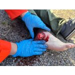 Wound moulage protruding small intestines