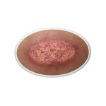 Frame Model Ulcus Cruris - clean wound