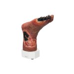 Necrotic foot model