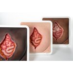 Frame Model Burst Abdomen - clean wound