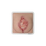 Rahmenmodell Platzbauch mit Granulationsgewebe - saubere Wunde