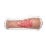 Frame Model Leg with Burn Injury Stage 3