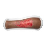 Frame Model Leg with Burn Injury Stage 3