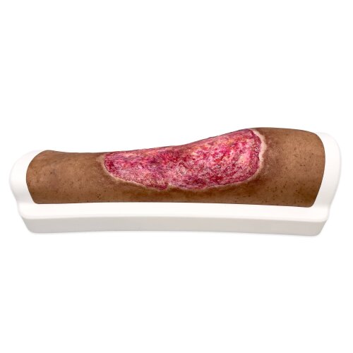 Rahmenmodell Venous Leg Ulcer (VLU) - venöses Beingeschwür
