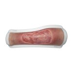 Rahmenmodell Venous Leg Ulcer (VLU) - ven&ouml;ses Beingeschw&uuml;r