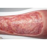 Rahmenmodell Venous Leg Ulcer (VLU) - venöses Beingeschwür