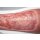 Rahmenmodell Venous Leg Ulcer (VLU) - venöses Beingeschwür