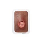Pocketwound Undermining - clean wound