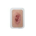 Pocketwound Pressure Ulcer - clean Wound