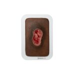 Pocketwound Pressure Ulcer - clean Wound