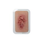 Pocketwound Ulcer - Chronic Wound - clean wound