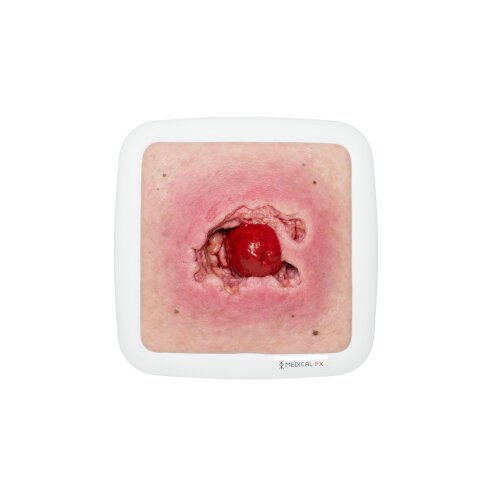 Frame Model Stoma Avulsion - clean wound, light