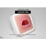 Frame Model Stoma Avulsion - clean wound, light
