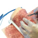 Cricothyroidotomy Haut mit Strahlenschaden