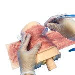 Cricothyroidotomy Haut mit Strahlenschaden