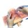 Cricothyroidotomy Skin burned by radiotherapy