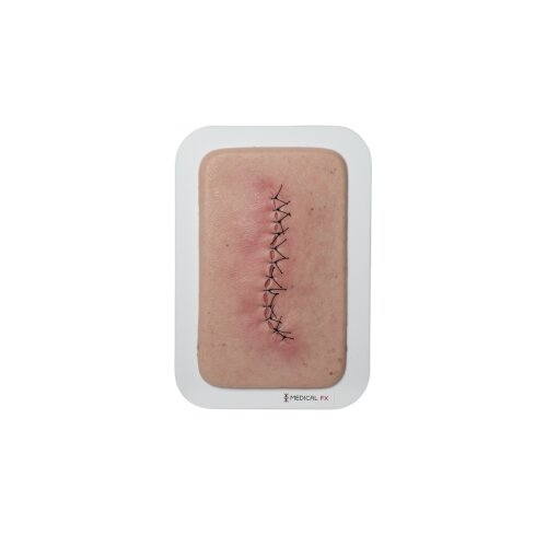 Pocketwound Surgical Wound Closed and Inflamed